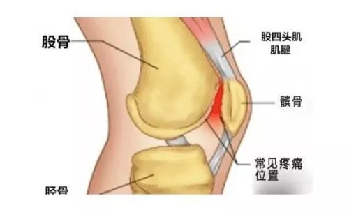 膝关节太"胖"?有可能是髌下脂肪垫损伤惹的祸