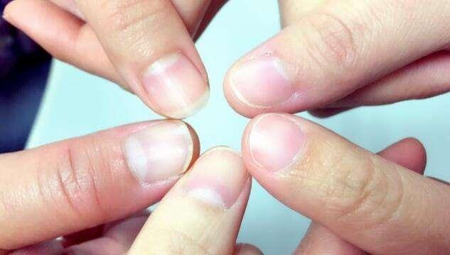 看指甲知健康,这5种指甲表现,都在说明你的健康生病了!