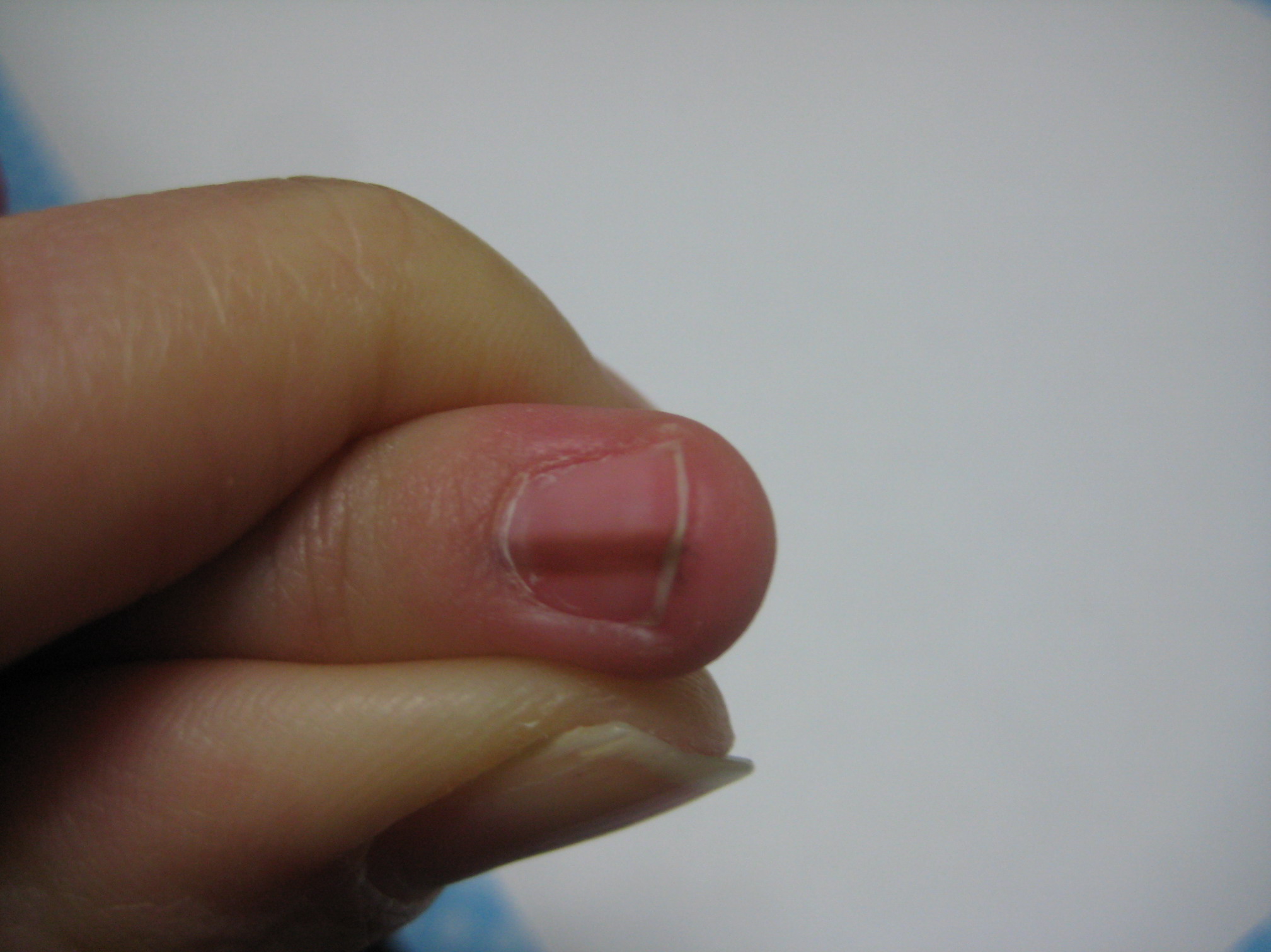 而指甲上的这条黑线叫做"甲母痣",当痣的部位受到刺激或者损伤时,黑
