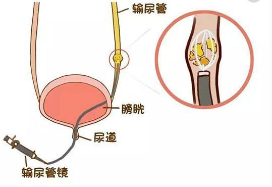 结石患者吃什么好,这些结石饮食禁忌你知道吗?