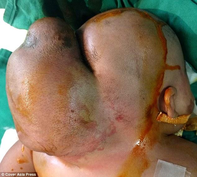 印度一婴儿天生畸形,脑后超大肉瘤酷似"双头人"