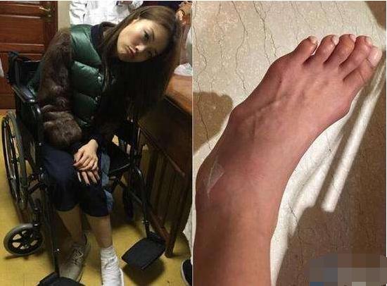 杨紫琼就被媒体拍到过穿凉鞋严重变了形的大脚趾
