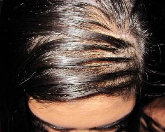 头发出油不仅会黏在头皮上让人感到不适,还会影响美观.