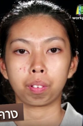泰国节目送暴牙妹到韩国整形,一个月后美到窒息!