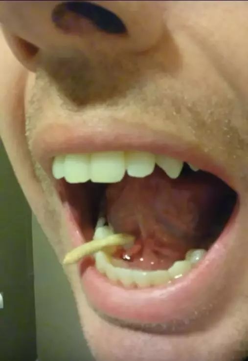 牙痛去检查 3厘米"怪虫"从舌下钻出
