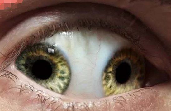 恐怖!世界上发现过最奇葩的眼睛变异现象,敢看完吗?