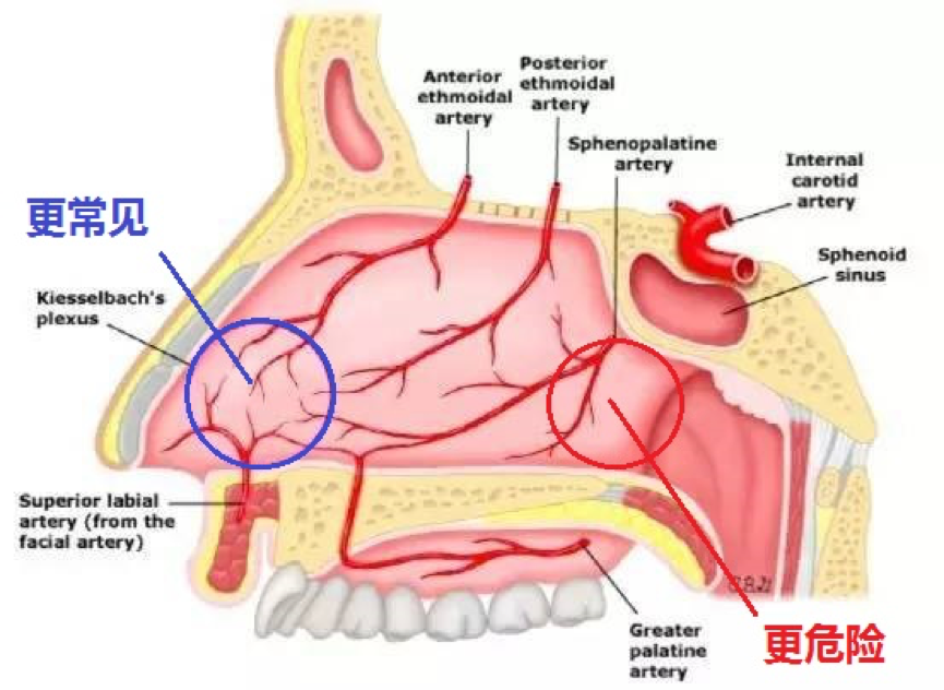 中老年人的鼻出血,常常與高血壓和動脈硬化有關,出血部位多見於鼻腔後