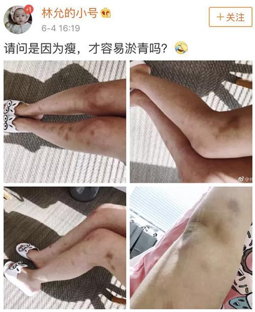 林允曬照雙腿全是淤青網友像是被家暴了